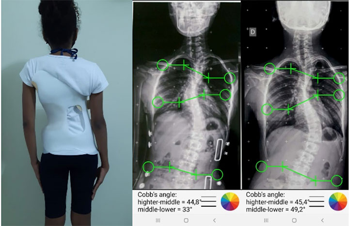 Colete Ortopédico 3D para Escoliose Movimento Centro de Terapias e Cursos